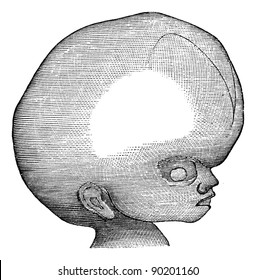 Hydrocephalus, Vintage Engraved Illustration.  Usual Medicine Dictionary By Dr Labarthe - 1885