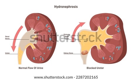 Hydronephrosis. Medical condition in which a kidney enlarge and swell as a result of urine accumulation. Kidney stone blocking the urine canal. Flat vector illustration