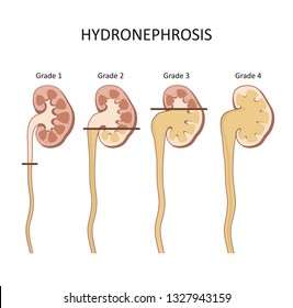 572 Hydronephrosis Images, Stock Photos & Vectors | Shutterstock