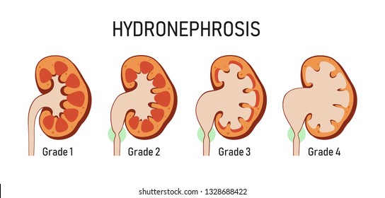 572 Hydronephrosis Images, Stock Photos & Vectors | Shutterstock