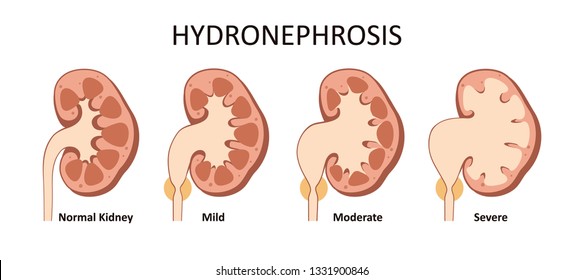 572 Hydronephrosis Images, Stock Photos & Vectors | Shutterstock