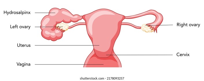 Hydrosalpinx Female reproductive system blocked fallopian tube uterus with description text. Human anatomy internal organs vector medical illustration flat style icon isolated on white background