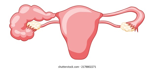 Hydrosalpinx Female reproductive system blocked fallopian tube uterus with description text. Human anatomy internal organs vector medical illustration flat style icon isolated on white background