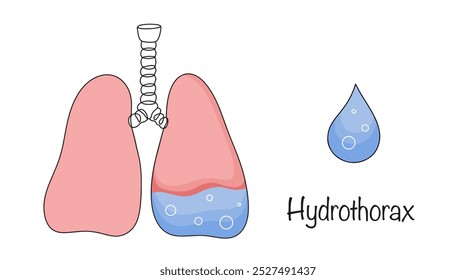 Hidrotórax. Uma condição em que o líquido se acumula na cavidade pleural. Pulmões puxados à mão com líquido no interior. Ilustração do vetor de cor sobre um tema médico.