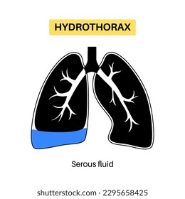 Enfermedad pulmonar por hidrotórax. Recogida no inflamatoria de fluidos séricos en cavidad pleural. Tos grave, dolor torácico, dificultad para respirar. Órganos internos poco saludables. Ilustración vectorial del sistema respiratorio