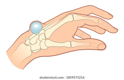 Hygroma on the hand. Medical vector illustration of hygroma with bones. 