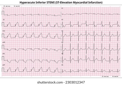 Hyperacute Inferior STEMI (ST-Elevation Myocardial Infarction) - 12 Lead ECG Common Case - 6 Sec lead - Vectors and Illustrations for Medical Purposes