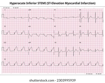 Hyperacute Inferior STEMI (ST-Elevation Myocardial Infarction) - 12 Lead ECG Common Case - 3 Sec per lead - Vectors and Illustrations for Medical Purposes