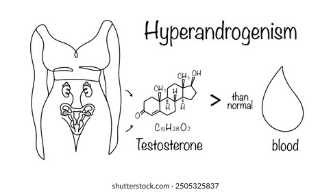Hiperandrogenismo. Una afección en la cual las glándulas suprarrenales y los ovarios de una mujer producen demasiada testosterona, que ingresa a la sangre. Aumento de las hormonas sexuales masculinas en la sangre de las mujeres. Vector.