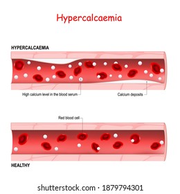 Hypercalcaemia. hypercalcemia is a high calcium level in the blood serum. Healthy blood vessel, and artery with Calcium deposits. comparison, and differences
