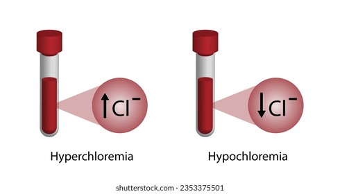 Hyperchloremia, high plasma chloride  level and Hypochloremia, low plasma chloride  level. Chloride  excess and deficit electrolyte disorders, blood droplet, Scientific design. Vector illustration.