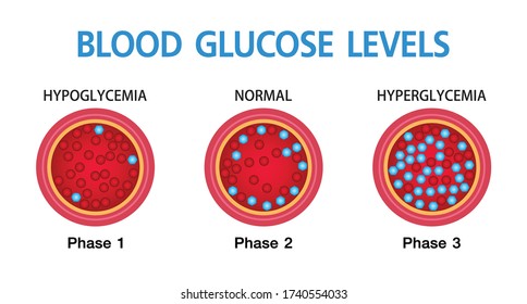 Hyperglycemia, High Blood Sugar And Diabetes ,obesity Is A Serious Medical Condition Causes, Vector Design.