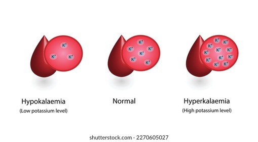 Hyperkalaemia, high plasma potassium level and Hypokalaemia, low plasma potassium level. Potassium K excess and deficit electrolyte disorders, blood test tube, Scientific design. Vector illustration.
