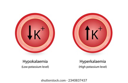 Hyperkalaemia, high plasma potassium level and Hypokalaemia, low plasma potassium level. Potassium K excess and deficit electrolyte disorders, blood test tube, Scientific design. Vector illustration.