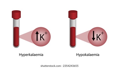 Hyperkalaemia, high plasma potassium level and Hypokalaemia, low plasma potassium level. Potassium K excess and deficit electrolyte disorders, blood test tube, Scientific design. Vector illustration.