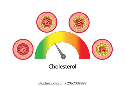 Hiperlipidemia, aterosclerosis. gráfico de colesterol con fondo blanco. Alto nivel de colesterol como riesgo aterosclerótico. ldl y hdl. Diseño de vectores.