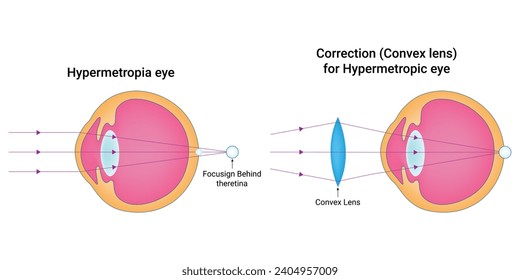 Hypermetropia eye Science Design Vector Illustration