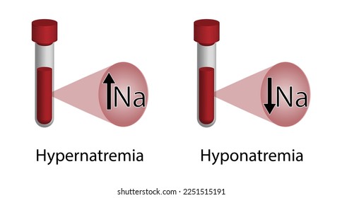 Hypernatremia, high plasma sodium level and Hyponatremia, low plasma sodium level. Sodium Na excess and deficit electrolyte disorders, blood test tube, Scientific design. Vector illustration.