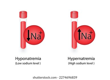 Hypernatremia, high plasma sodium level and Hyponatremia, low plasma sodium level. Sodium Na excess and deficit electrolyte disorders, blood test tube, Scientific design. Vector illustration.