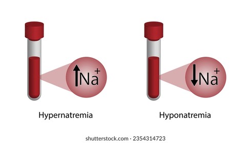 Hypernatremia, high plasma sodium level and Hyponatremia, low plasma sodium level. Sodium Na excess and deficit electrolyte disorders, blood test tube, Scientific design. Vector illustration.