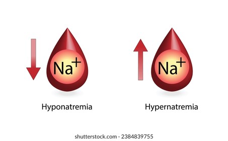 Hypernatremia, high plasma sodium level and Hyponatremia, low plasma sodium level. Sodium Na excess and deficit electrolyte disorders, blood test tube, Scientific design. Vector illustration.