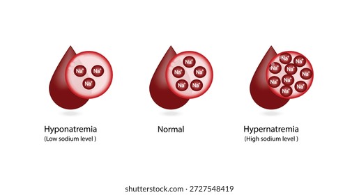 Hipernatremia, níveis plasmáticos elevados de sódio e Hiponatremia, níveis plasmáticos baixos de sódio. Distúrbios eletrolíticos de excesso e deficit de sódio na, tubo de exame de sangue, desenho científico. Ilustração vetorial.