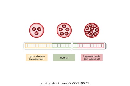 Hipernatremia, níveis plasmáticos elevados de sódio e Hiponatremia, níveis plasmáticos baixos de sódio. Distúrbios eletrolíticos de excesso e deficit de sódio na, tubo de exame de sangue, desenho científico. Ilustração vetorial.