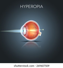 Hyperopia. Hyperopia is being long sighted (far sighted). Near object seems blurry. Hyperopia corrected by a plus lens. Detailed anatomy of the eye, cross section.