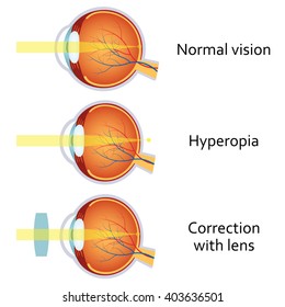 rövidlátás mik az emberek hyperopia myopia a