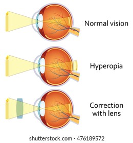 Torna a szemnek a látás javítása érdekében hyperopia esetén