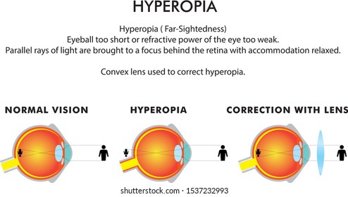Hyperopia in eye disorders vector illustration