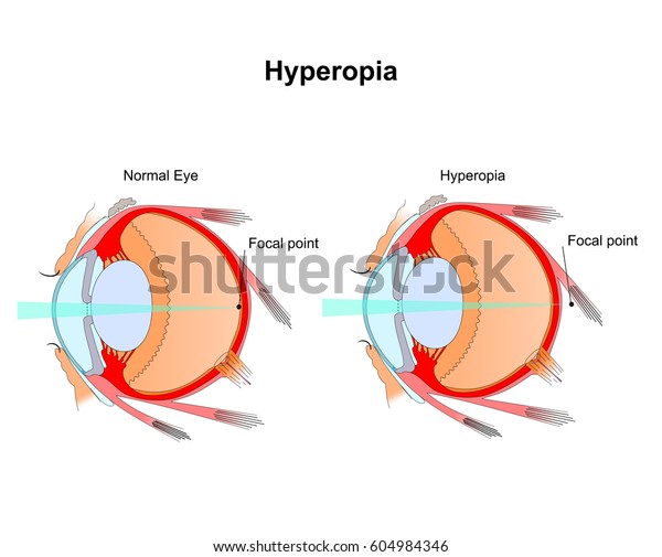 Hyperopia Eye Vision Disorderdiagram Eye Stock Vector (Royalty Free ...