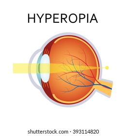 Hyperopia eyesight disorder. Hyperopia is being farsighted. Anatomy of the eye, cross section.