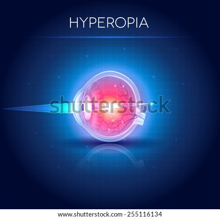 Hyperopia eyesight disorder. Hyperopia is being farsighted. Anatomy of the eye, cross section. 