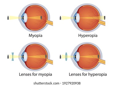 hyperopia és myopia megkülönböztetés