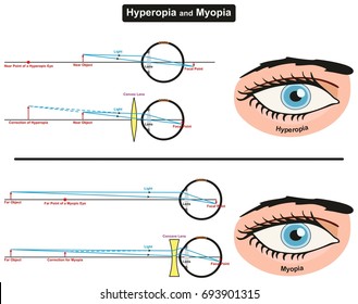 Hyperopia And Myopia Infographic Diagram Showing Comparison Between Them Including Far And Near Object Focal Points Eye Retina And Correction Convex And Concave Lens For Medical Science Education