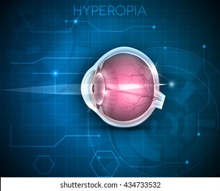 Hyperopia, vision disorder on a blue technology background. Being long sighted (far sighted), near object seems blurry. 