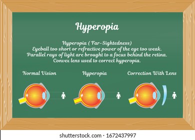 hyperopia, vision disorders and correction lens.
