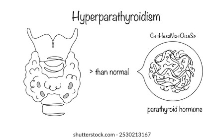 Hiperparatireoidismo. Uma doença do sistema endócrino causada pela produção excessiva de hormônio da paratireoide. Uma glândula tireoide desenhada e uma imagem simbólica do hormônio da paratireoide. Ilustração vetorial.