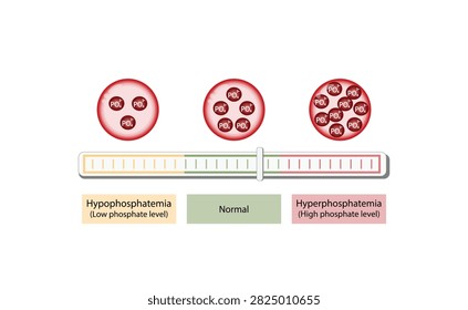 Hyperphosphatemia, high plasma phosphate level and Hypophosphatemia, low plasma phosphate level. phosphate excess and deficit electrolyte disorders, blood droplet, Scientific vector illustration.