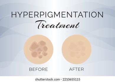 Hyperpigmentierung Behandlung vor und nach Illustration Design