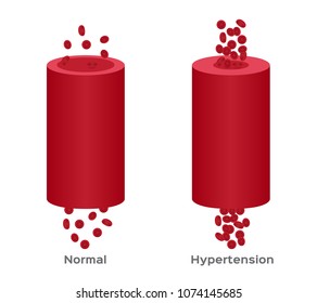 Hypertension , High Blood Pressure Vector / Human Anatomy