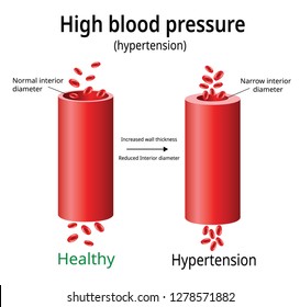 1,685 Blood pressure diagram Images, Stock Photos & Vectors | Shutterstock