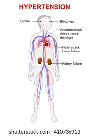 hypertension increases risk of heart attack, stroke, and kidney failure.