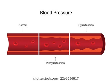 Vector de hipertensión, diseño de ilustración causa alta presión arterial