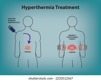 Hyperthermia Treatment, Magnetic Hyperthermia Therapy, Injecting Magnetic Nanoparticles. Tumor or Tumour Treatment