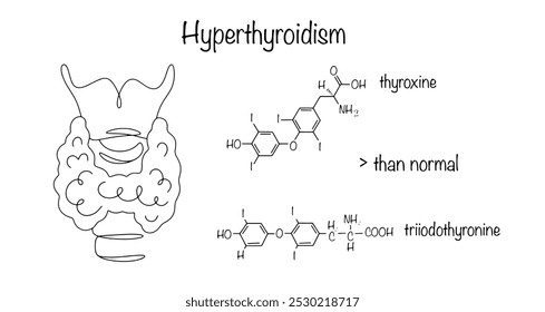 Hyperthyroidism. A disease of the thyroid gland in which the organ produces excessive amounts of thyroid hormones. Drawn thyroid gland and chemical formulas of hormones that are produced in excess.