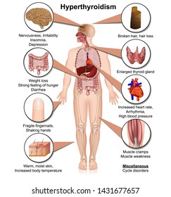 Hyperthyroidism medical vector illustration isolated on white background infographic eps 10