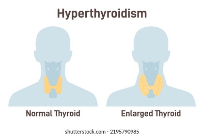 Hyperthyroid Svg