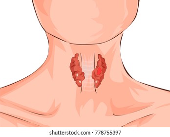 Hyperthyroidism and trachea shown on a woman. Medical concept. Anatomy of people. Vector illustration.